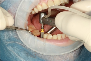 Implant placement in the mouth with retraction achieved with OptraGate