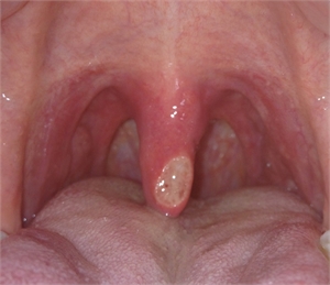 Ulcer on Uvula