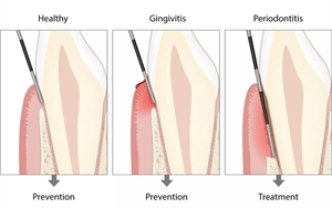 Probing periodontal pockets to measure and code BPE - basic periodontal examination