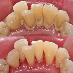Teeth Scaling Procedure