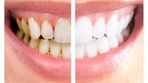 Teeth scaling is also known as tartar removal or dental scaling