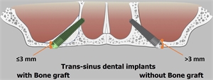 Trans sinus dental implants
