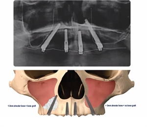 Trans-sinus implants x-ray