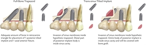 Trans sinus dental implants
