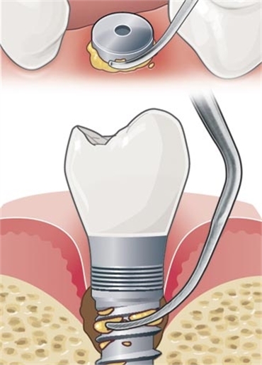 Should the dental hygienist perform scaling procedure around my dental implants?