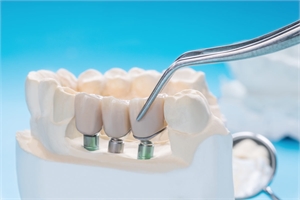 Tooth implants should be maintained and cleaned with a scale and polish procedure. However, different equipment should be used compared to cleaning natural teeth