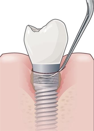 Dental scaling of calculus and plaque around tooth implants