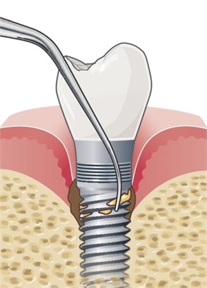 Removing tartar deposits around dental implant