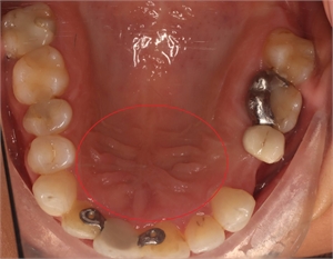 Palatal rugae in patient's mouth. Palatine rugae are circled in red