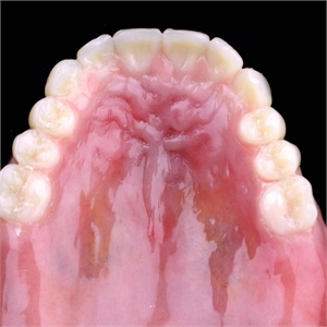 Replicating palatine rugae on the upper denture changes the patient speech and can avoid lisping