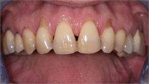 Exposed tooth roots in patients mouth