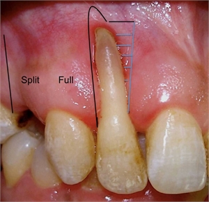 Full root exposure due to severe gum disease issues
