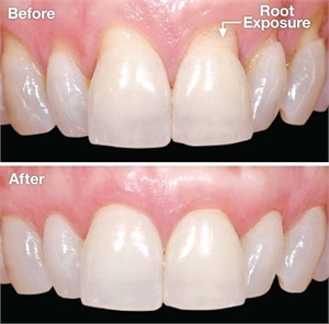 Root exposure treatment - periodontal surgery - before and after photo