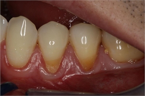 Teeth roots exposed due to gum recessions