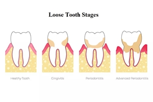 Stages of a loose tooth
