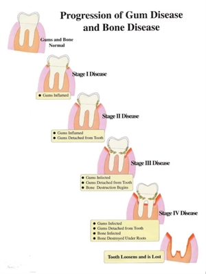 Stages of gum disease (periodontal disease)
