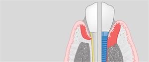 What is the difference between gingivitis and mucositis?