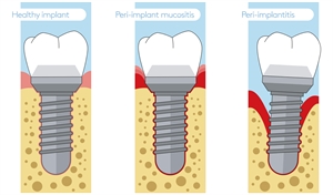 Difference between mucositis and peri-implantitis