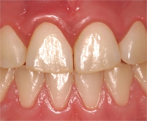 Gingivitis is a reversible condition of gum inflammation