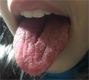 What is fissured tongue?