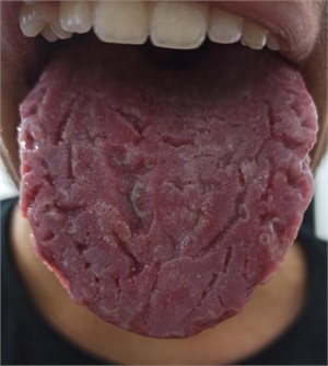 Fissured tongue is also known as lingua plicata and scrotal tongue