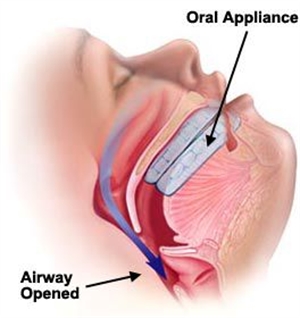 Dentist's Role in Sleep Apnea Treatment