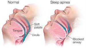 Sleep apnea airway obstruction