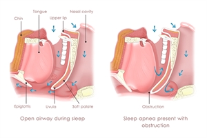 Sleep apnea causes and anatomy of airway obstruction