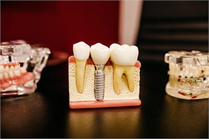 Tips For Dental Implants Aftercare