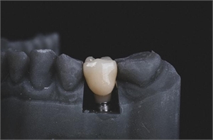 Ceramic implant dental crown on a lab model