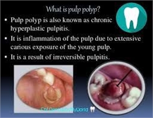 Pulp polyp - everything you need to know