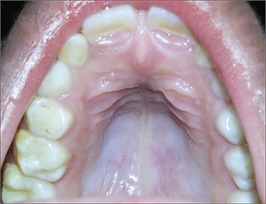 High-arched or gothic palate - deep and narrow roof of the mouth