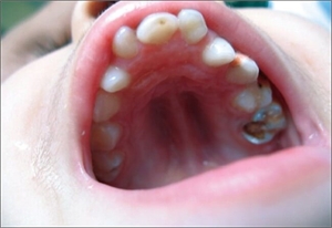 High-arched palate is also known as high-vaulted palate or gothic palate