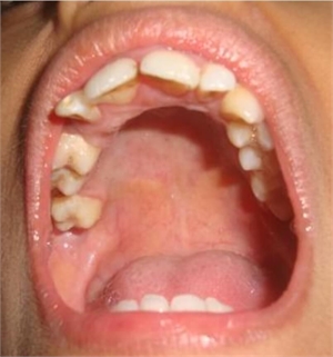 High-arched palate is also known as gothic palate or bubble palate
