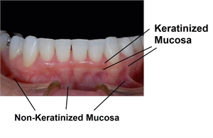What is the difference between keratinized and non-keratinized gingival mucosa in the oral cavity