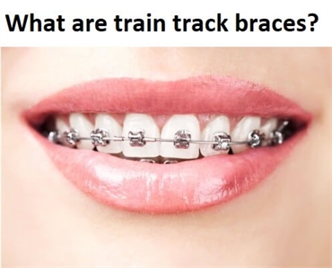 What are train track braces?
