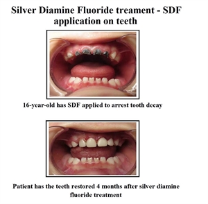 Does Silver Diamine Fluoride permanently stain teeth?