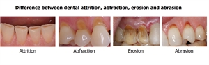 What is the difference between dental attrition, abfraction, erosion and abrasion?