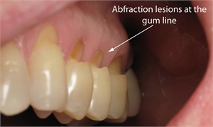 Dental abfraction is a non carious tooth lesion caused by tooth flexure. It appears at the gum margins like V-shaped grooves.