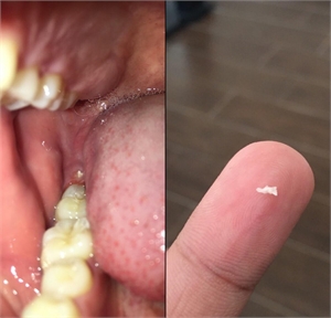 I can see a bone spur in my gums. What should I do?