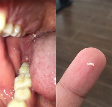 I can see a bone spur in my gums. What should I do?