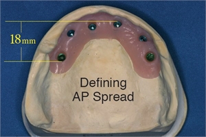 What is AP spread in dentistry?