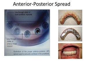 AP spread means anterior-posterior spread or distance between the most anterior and the most posterior dental implant