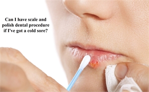 Can I have scale and polish dental procedure if I've got a cold sore?