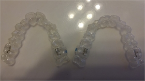 New technology transparent clear aligners Invisalign