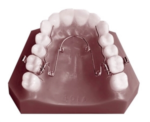 Quad Helix orthodontic appliance