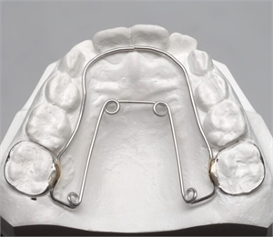 Quad helix can expand mandibular and maxillary arches and create space for orthodontic alignment of the teeth