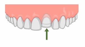 What is the treatment of tooth intrusion?
