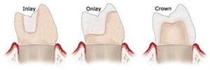 Inlay, onlay and dental crown
