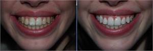 Enamel microabrasion before and after